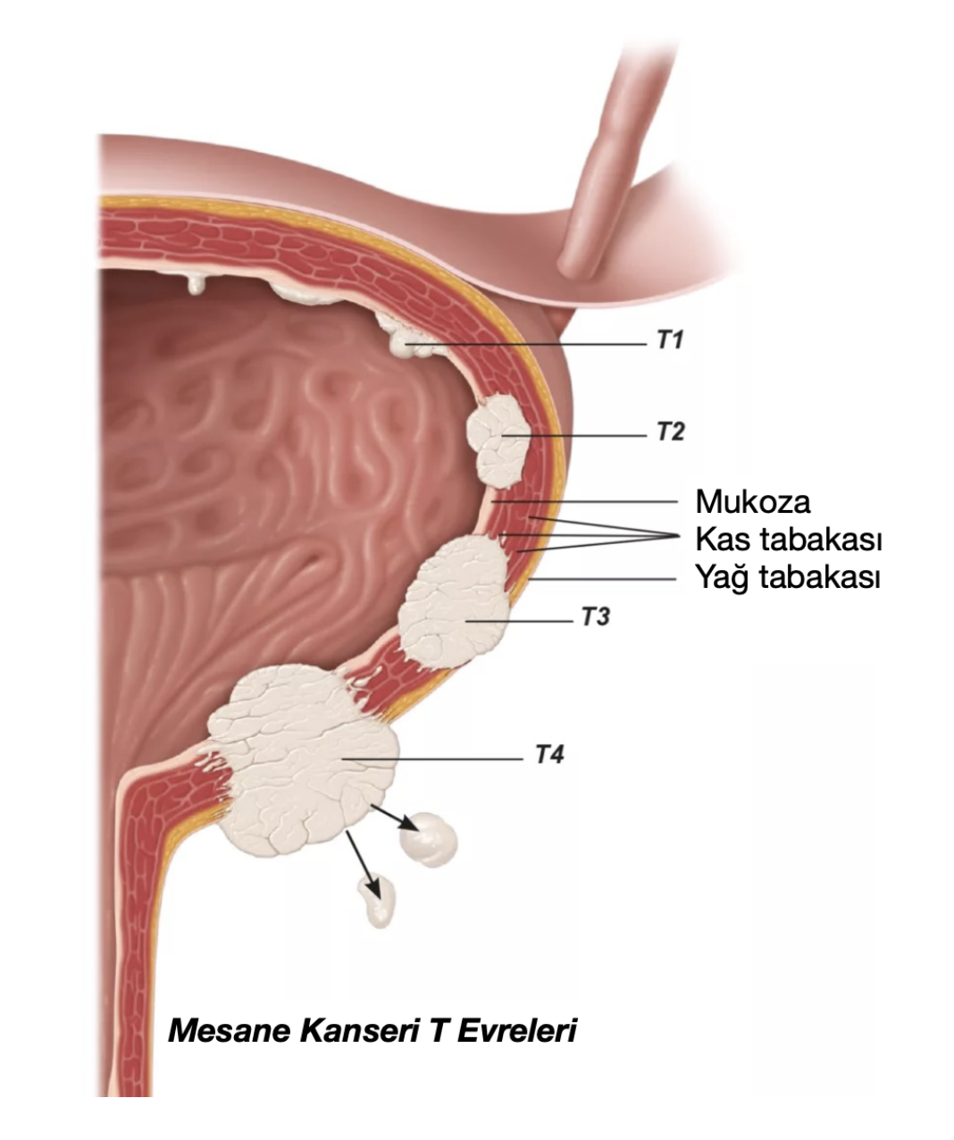mesane kanseri evreleri