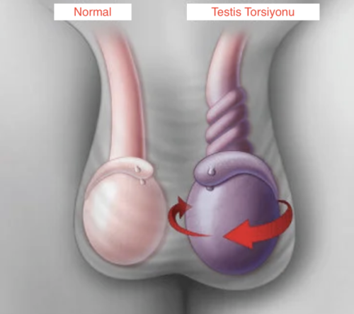 testis ağrısı