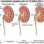 böbrek yetmezligi neden olur